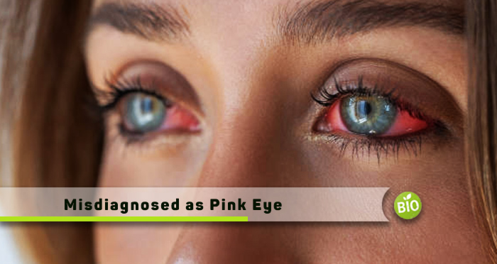 misdiagnosed-as-pink-eye